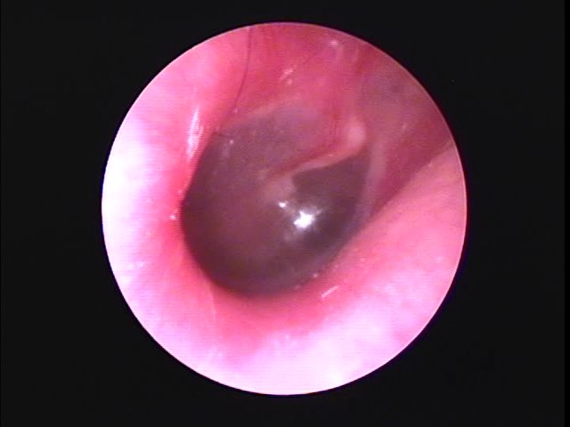 正常の鼓膜（外耳炎の画像）