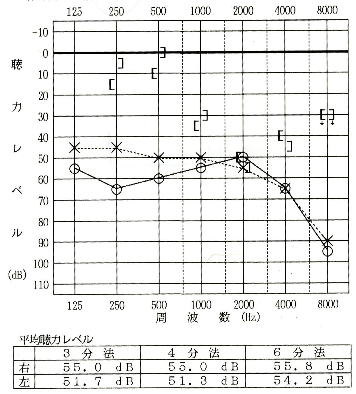 聴力検査（両耳中等度難聴）