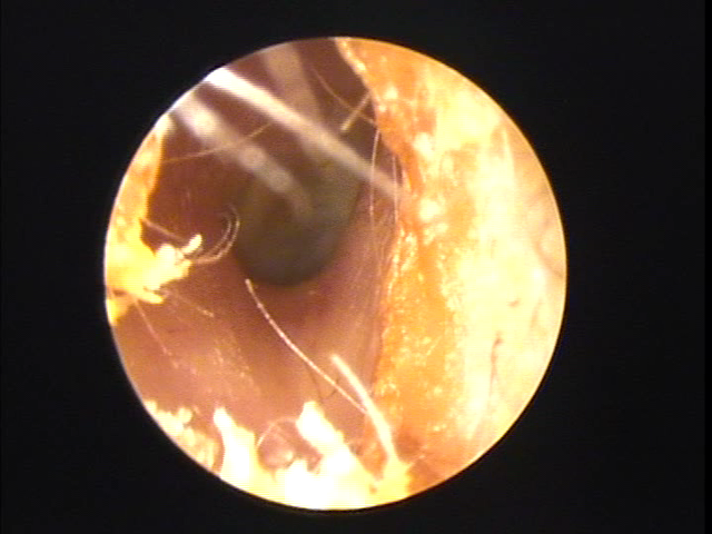 大分県宇佐市の方の耳垢掃除の写真（補聴器）