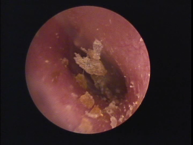 宮崎県児湯郡高鍋町の方の耳垢掃除の写真（補聴器）