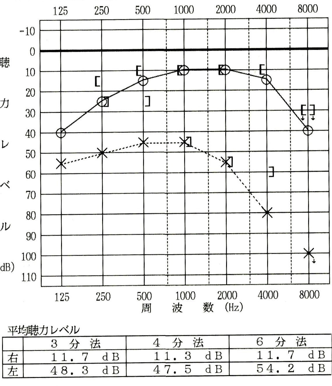 聴力検査（耳鳴り）