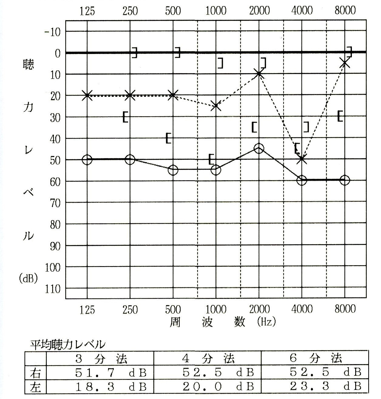 右耳難聴聴力図