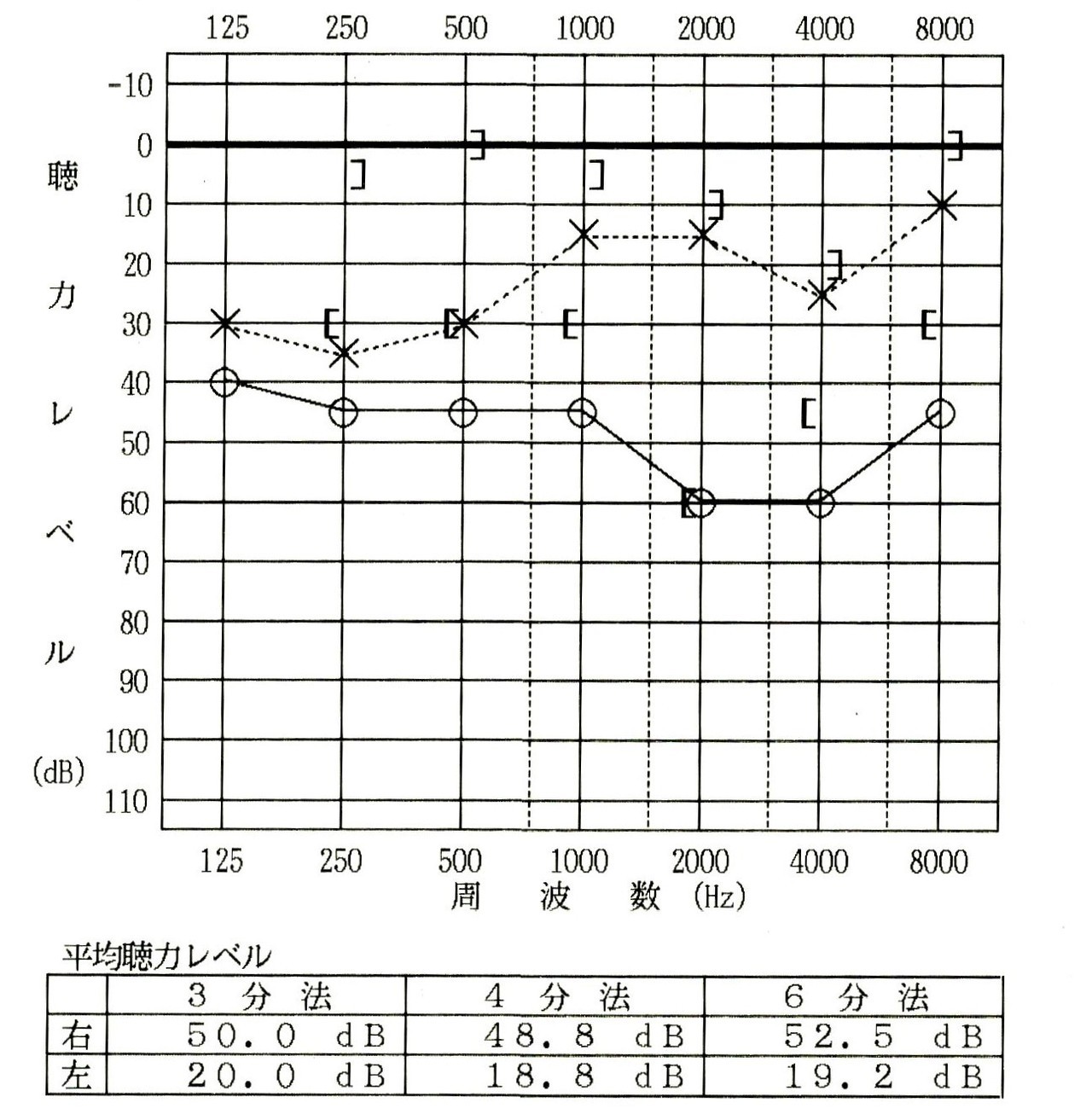 右感音難聴と右耳鳴り