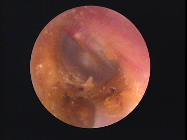 外耳道真珠腫の画像