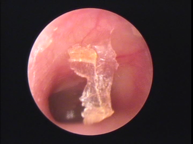 大分県大分市の方の耳垢掃除の写真（補聴器）