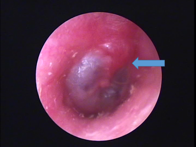軽度の赤い中耳炎