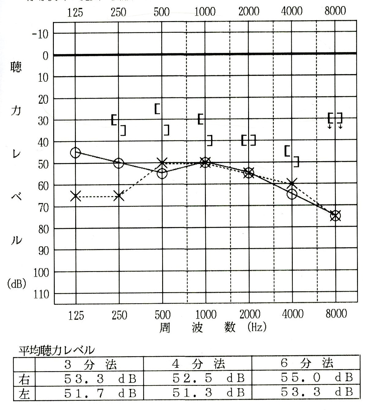 聴力検査（両耳中等度難聴）