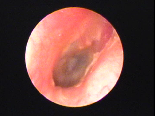外耳炎　治療途中の画像