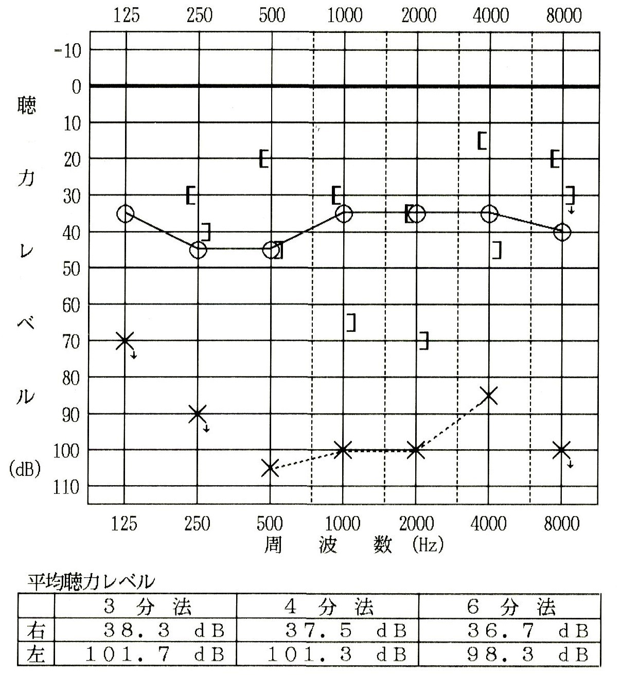 聴力検査（左耳難聴）