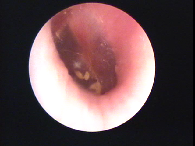大阪府大阪市東成区の方の耳あか掃除の画像(外耳炎)