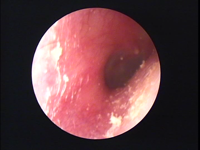 外耳炎を起こしている長崎県佐世保市の方の耳垢掃除の画像