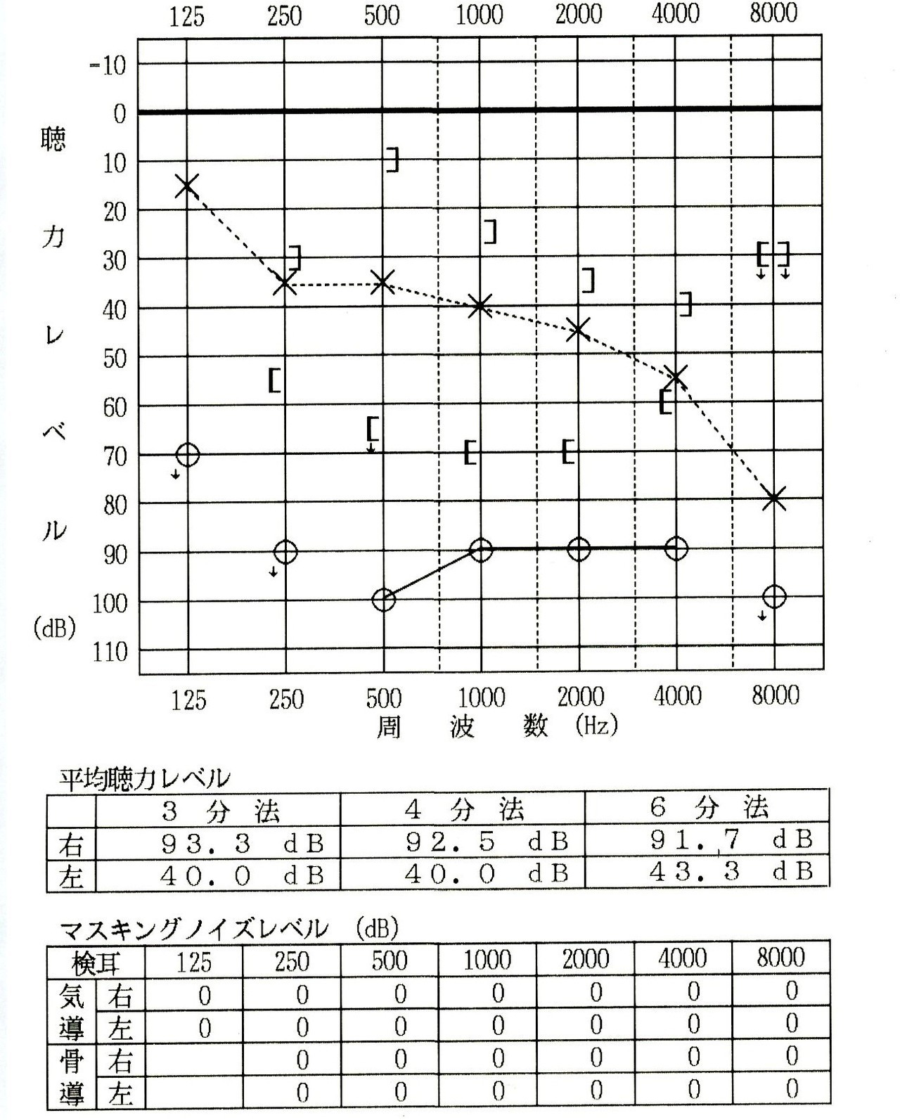 右耳難聴聴力図