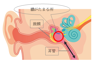 急性中耳炎の図
