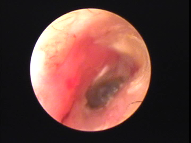 糜爛を起こしている外耳道炎の画像