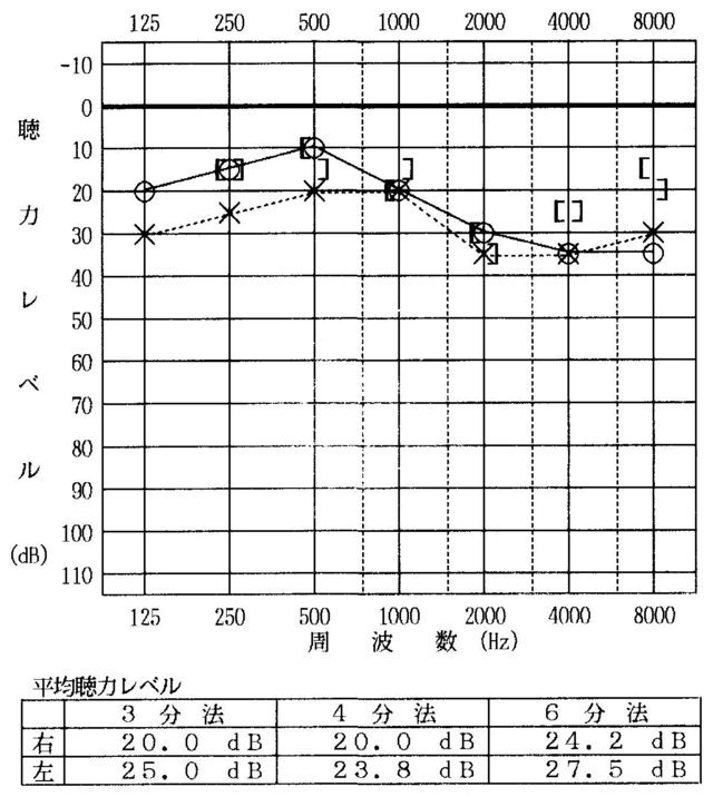 聴力検査（耳鳴り）