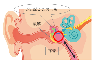 滲出性中耳炎