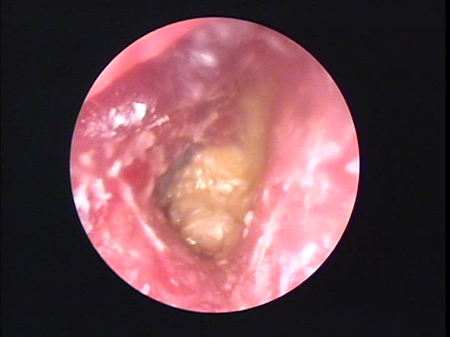 耳垢と外耳炎の画像