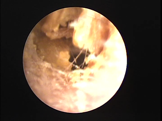 耳垢掃除の写真 宿久耳鼻咽喉科 福岡県福岡市博多区