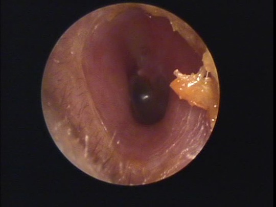 耳垢掃除の写真 宿久耳鼻咽喉科 福岡県福岡市博多区