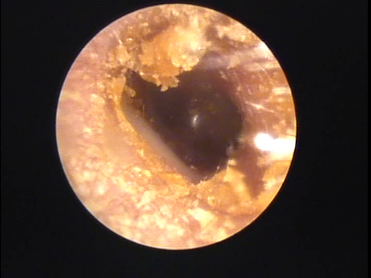 愛知県の方の耳あかそうじの写真 画像 宿久耳鼻咽喉科 福岡県福岡市博多区 愛知県の方の耳あかそうじの写真 画像 宿久耳鼻咽喉科 福岡県福岡市博多区