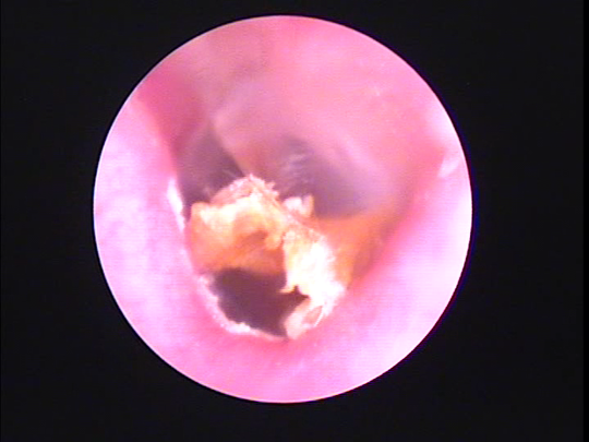 福岡県の方の耳あかそうじの写真 画像 宿久耳鼻咽喉科 福岡県福岡市博多区