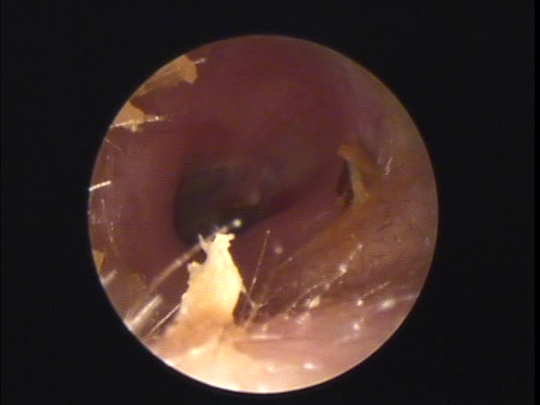 大分県の方の耳あかそうじの写真 画像 宿久耳鼻咽喉科 福岡県福岡市博多区