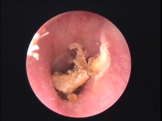 鼓膜 に 耳垢